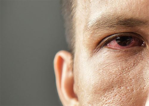 How is dry eye treated?