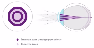 Myopia Control 1 how does misight 1 day work img
